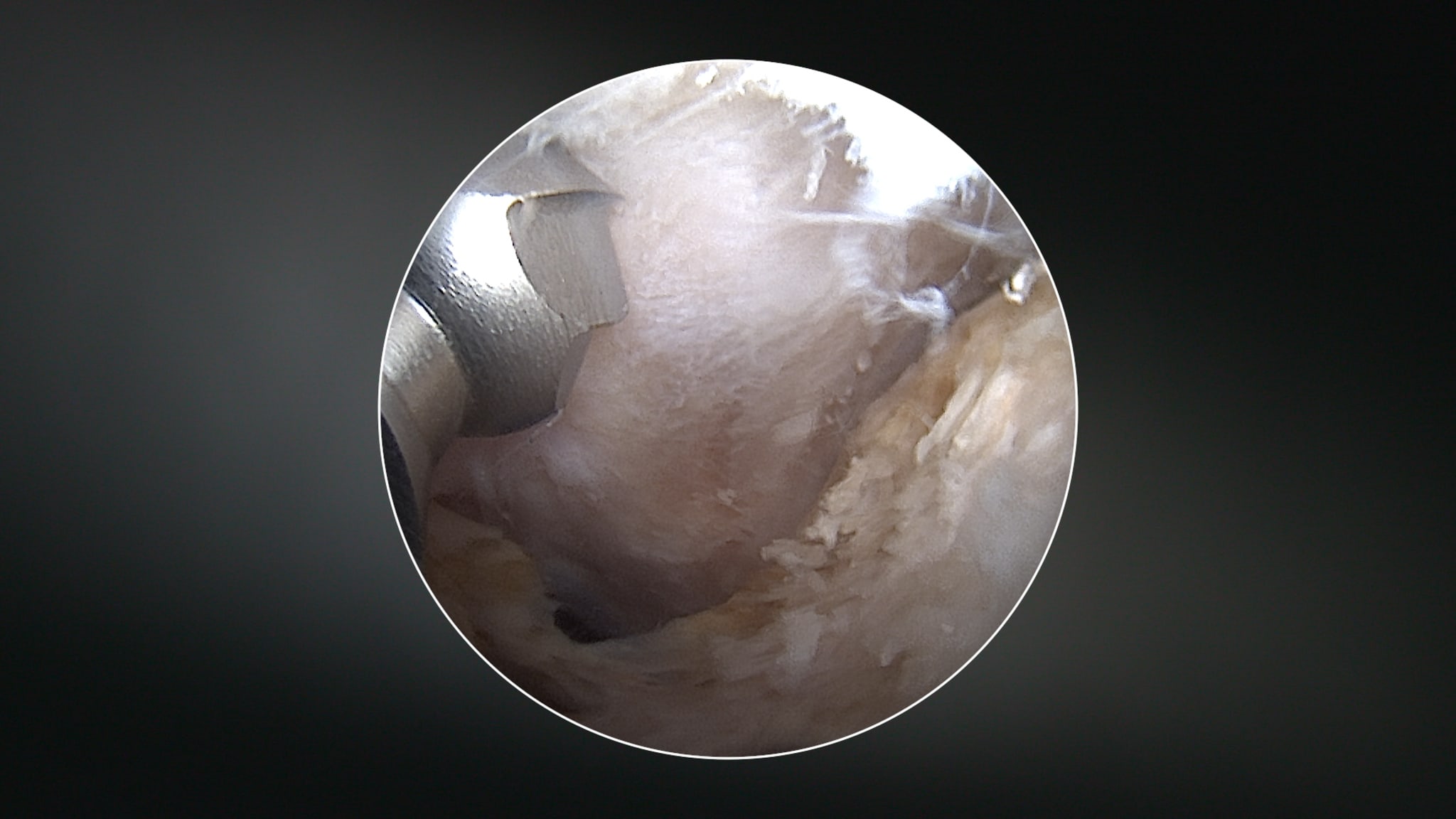 Medial Cam Osteochondroplasty Resection of the Femoral Neck Using aCurved Burr