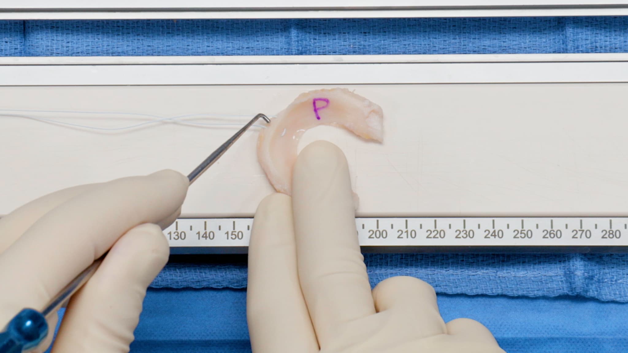Soft-Tissue Meniscal Allograft Transplantation With SutureLoc™ Implant for Meniscal Root Fixation