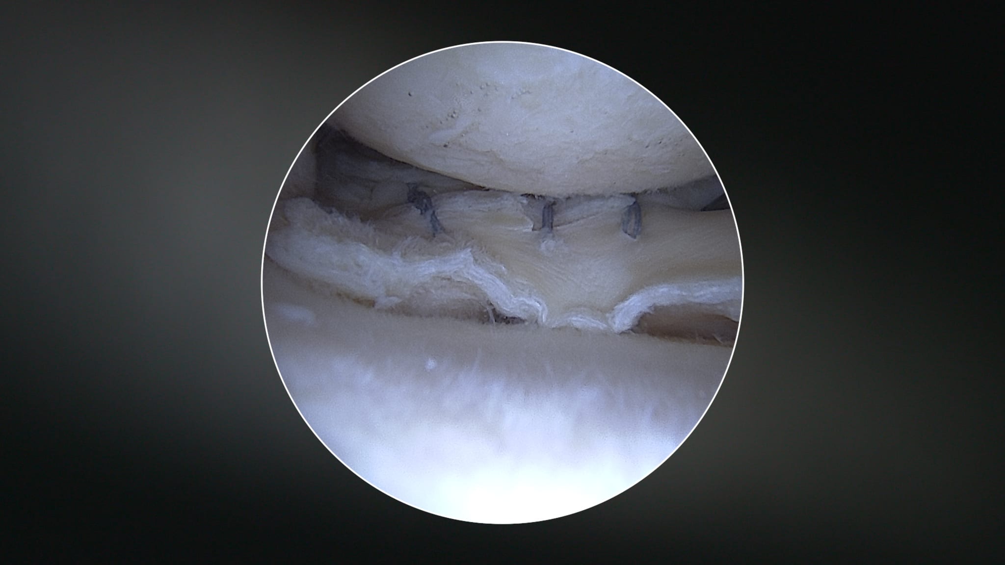 Sequential All-Inside Meniscal Reduction Using the All-Suture FiberStitch™ Implant