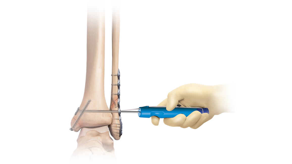Ankle Fracture Management System