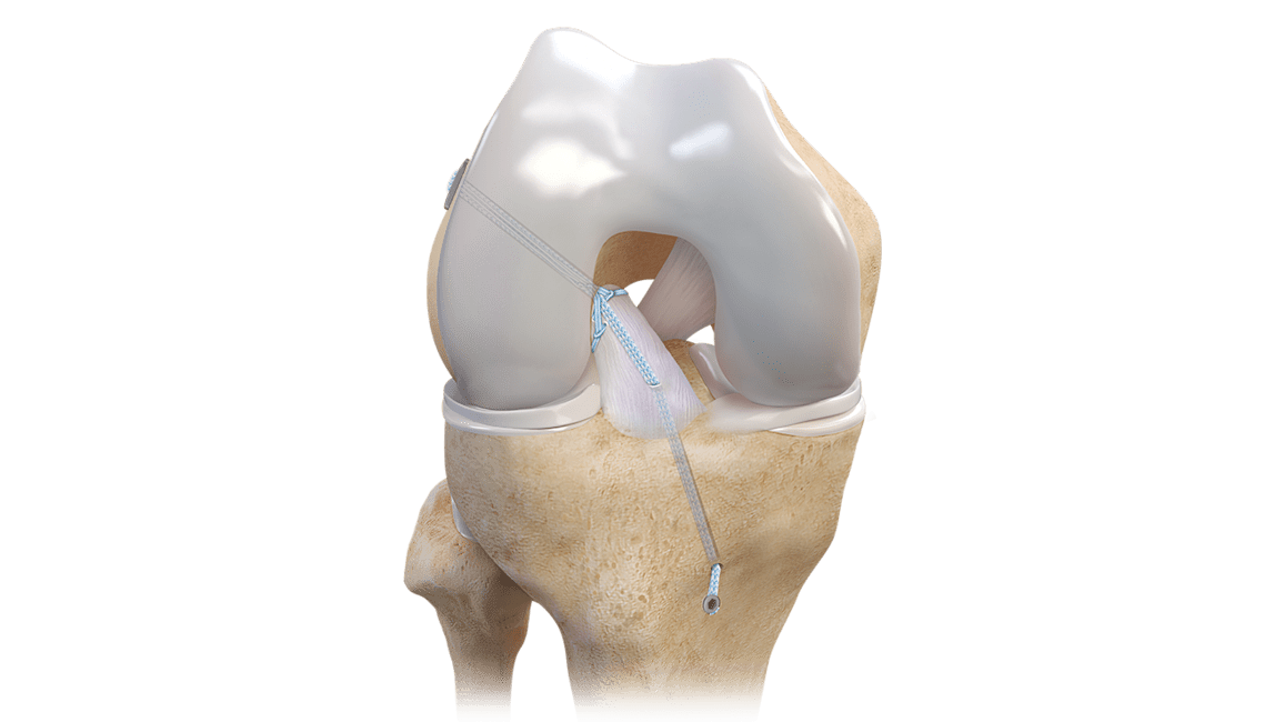 ACL Repair TightRope® Implant With FiberRing™ Sutures