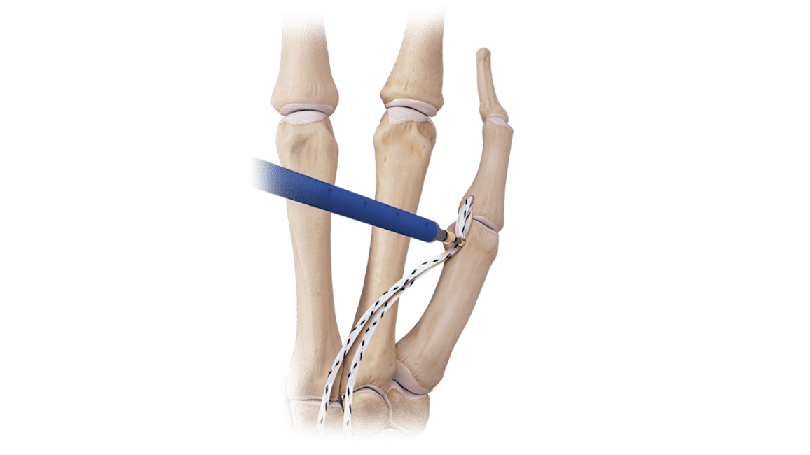 Hand/Wrist <em>Internal</em>Brace™ Ligament Augmentation Repair Convenience Kit