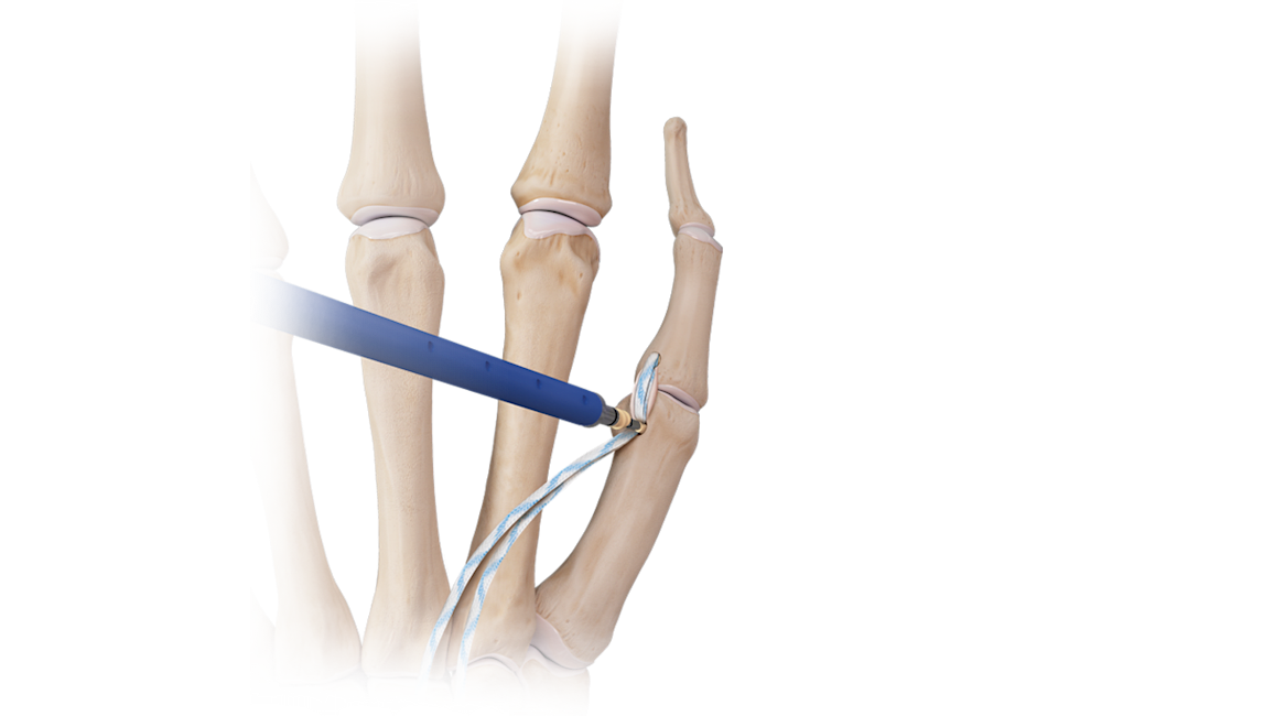 Hand/Wrist <em>Internal</em>Brace™ Ligament Augmentation Repair
