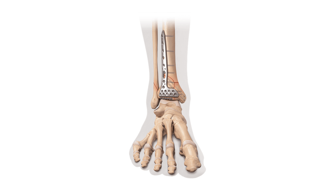 Internal Fixation for Distal Tibia Fracture/Pilon