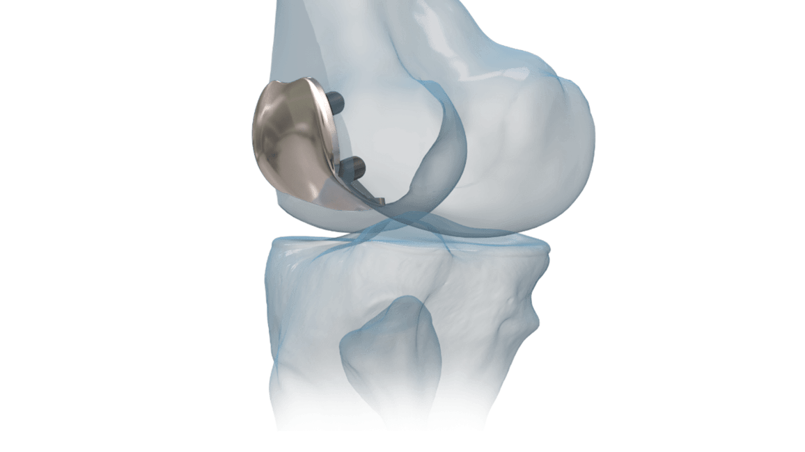 iBalance<sup>®</sup> PFJ System