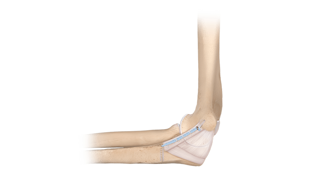 Sistema <em>Internal</em>Brace™ para LCC