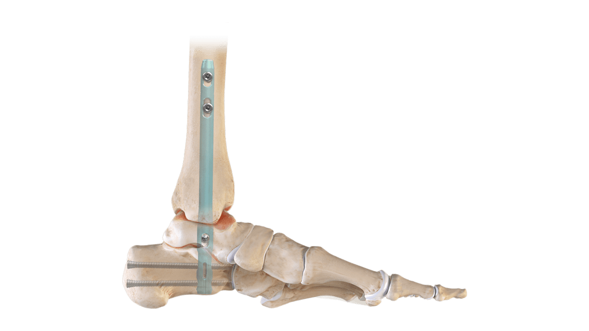 DualCompression Hindfoot Nail