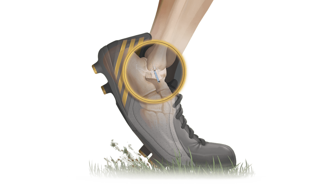 <em>Internal</em>Brace™ Technique for Brostrom Repair