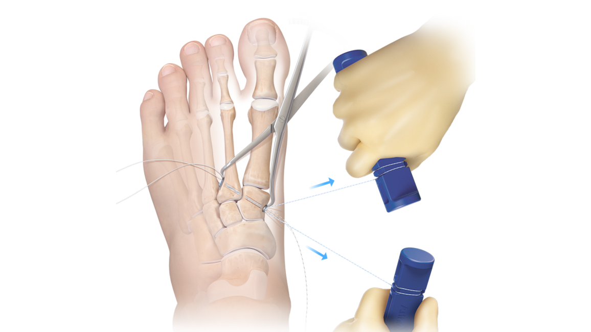 Sistema de fixação Mini TightRope<sup>®</sup>