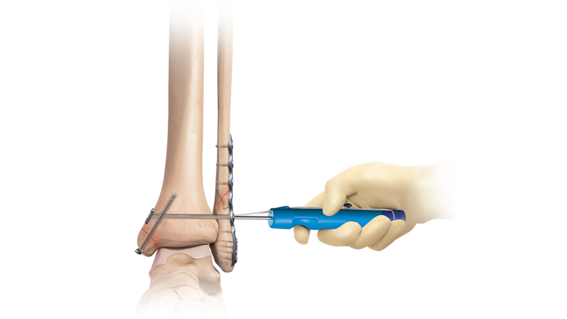 Sistema de manejo de fracturas para el tobillo