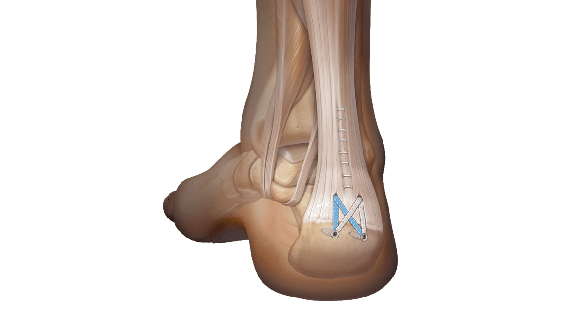 Achilles SpeedBridge™ Repair