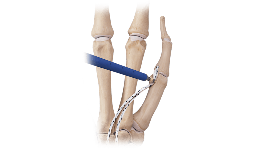 Hand/Wrist <em>Internal</em>Brace™ Ligament Augmentation Repair Convenience Kit