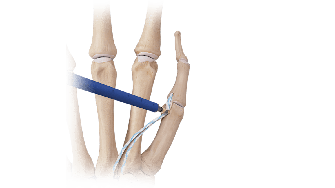 Hand/Wrist <em>Internal</em>Brace™ Ligament Augmentation Repair