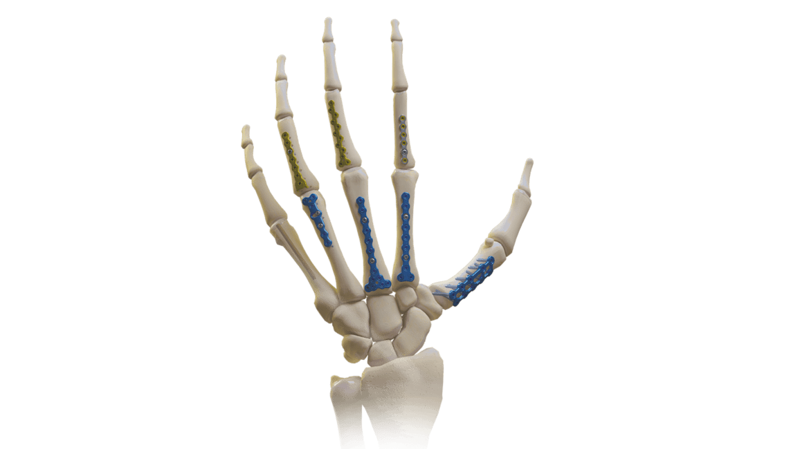 Umfassendes Mini-Fixierungssystem (Hand und Handgelenk)