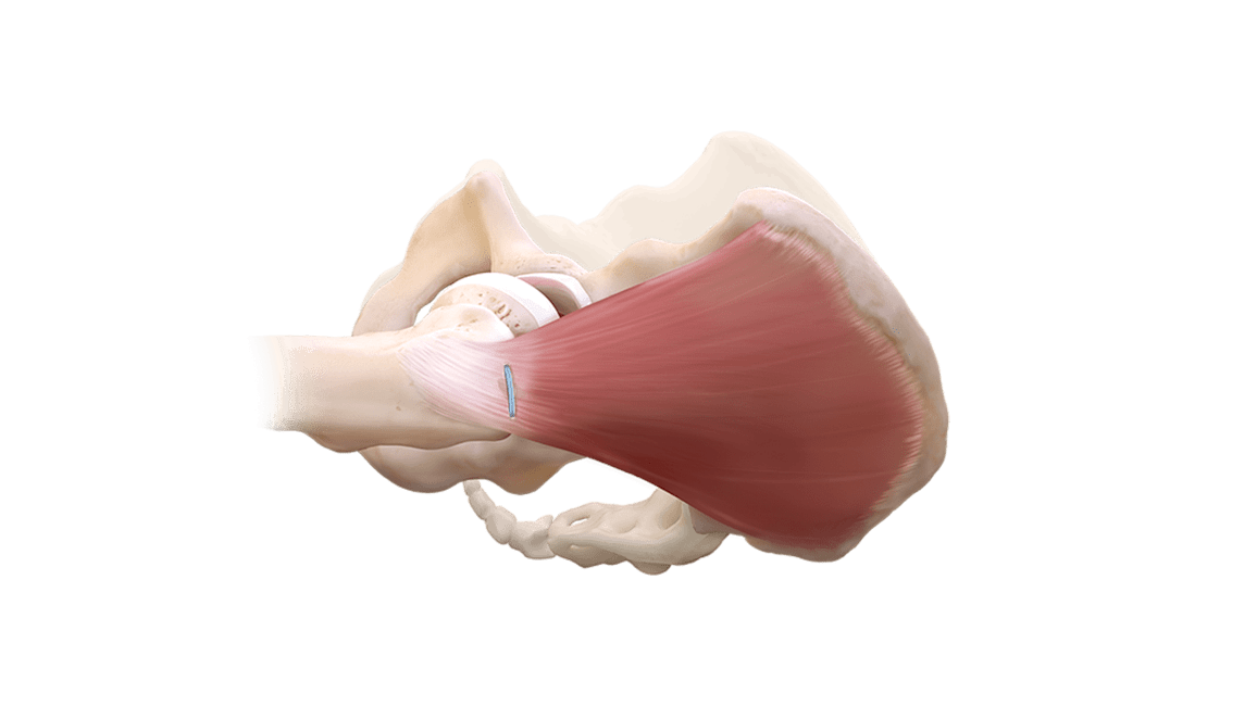 Rekonstruktion des Gluteus medius