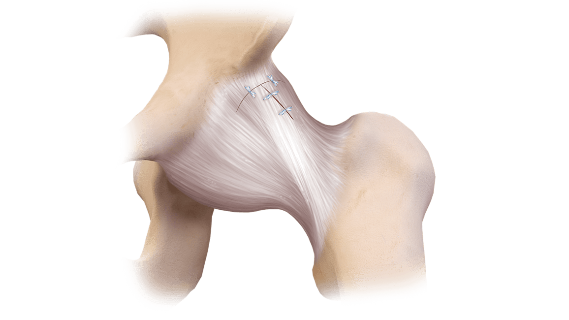 LoopLoc™ Knotless Implant