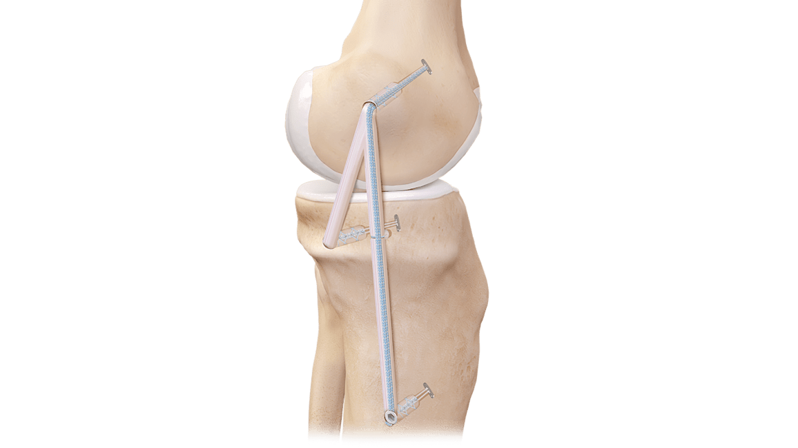 Medial Collateral Ligament (MCL) Reconstruction