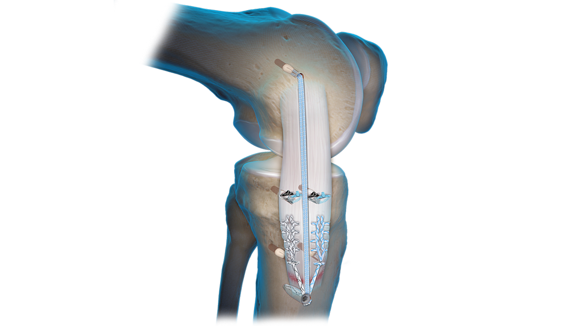 Medial Collateral Ligament (MCL) Repair 