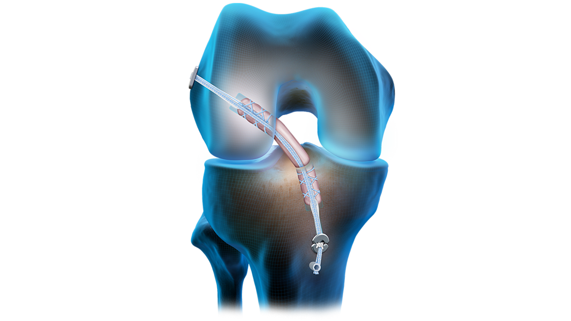 Quad Tendon Graft ACL Reconstruction