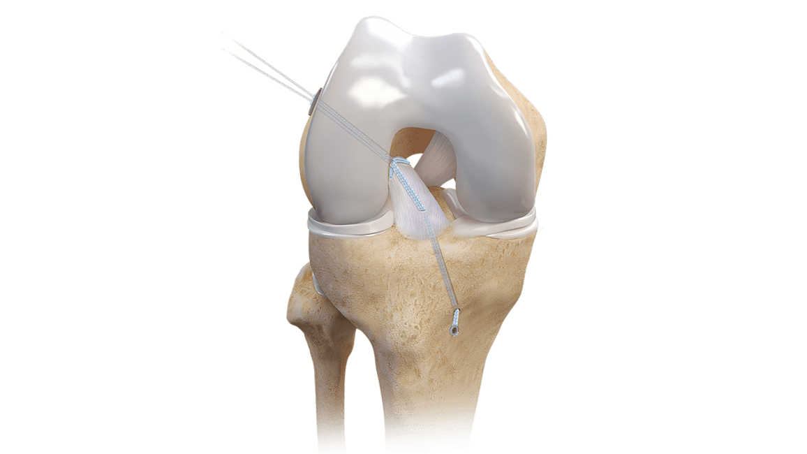 ACL Repair TightRope® Implant With FiberRing™ Sutures