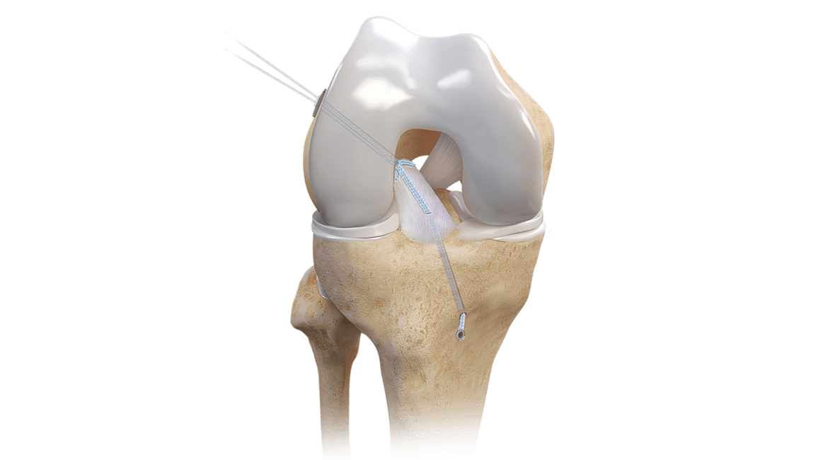 Reparación con el implante TightRope® con suturas FiberRing™