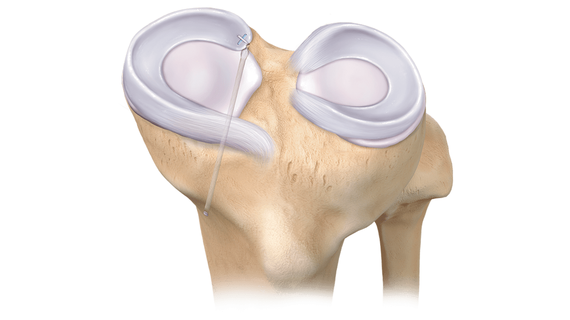 Reparo da raiz meniscal