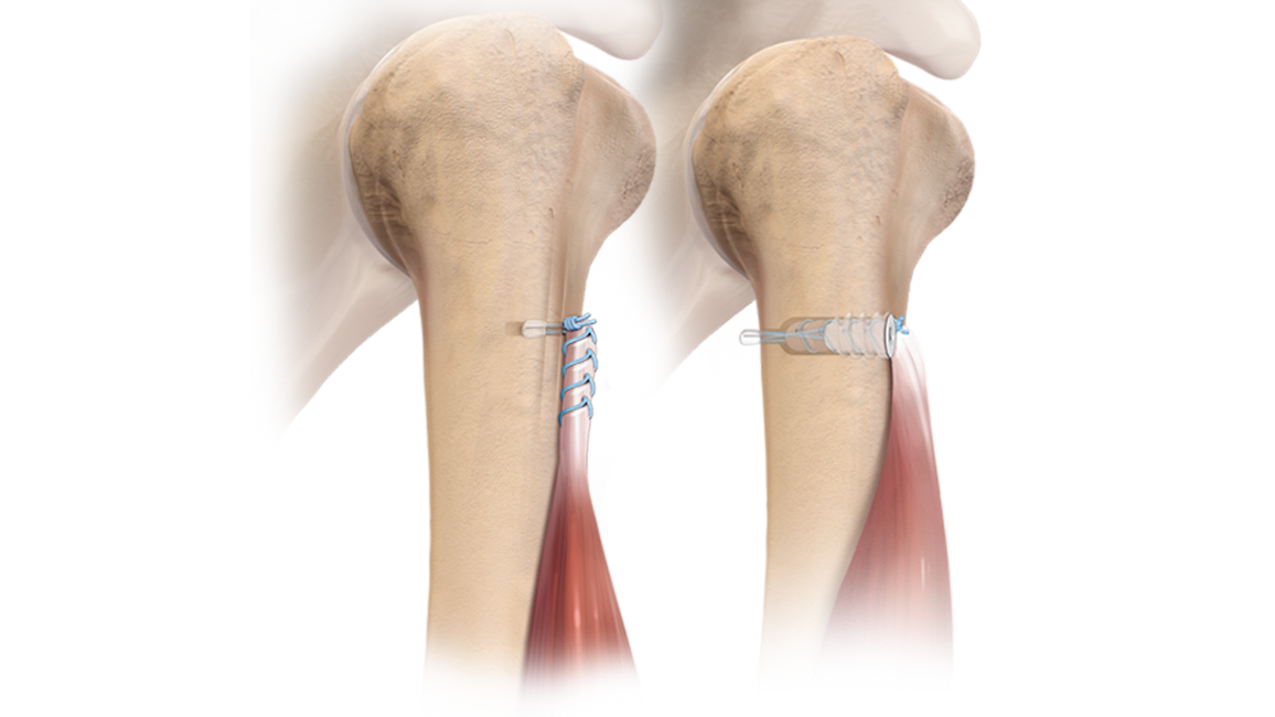 Técnica para tenodesis con FiberTak<sup>®</sup>