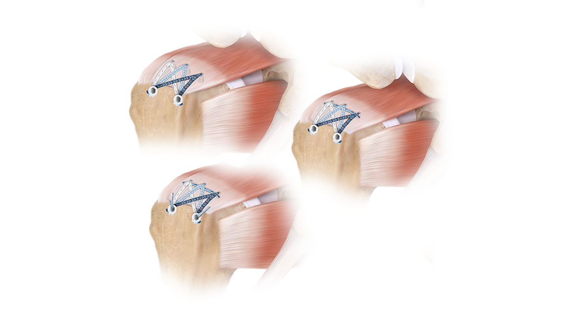 FiberTak® SpeedBridge™-Rotatorenmanschettenrekonstruktion