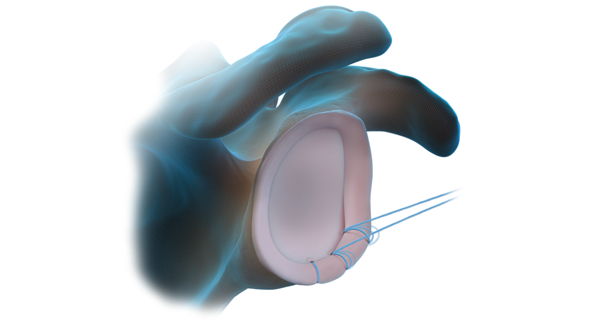 Técnica com âncora FiberTak<sup>®</sup> sem nós para tecidos moles