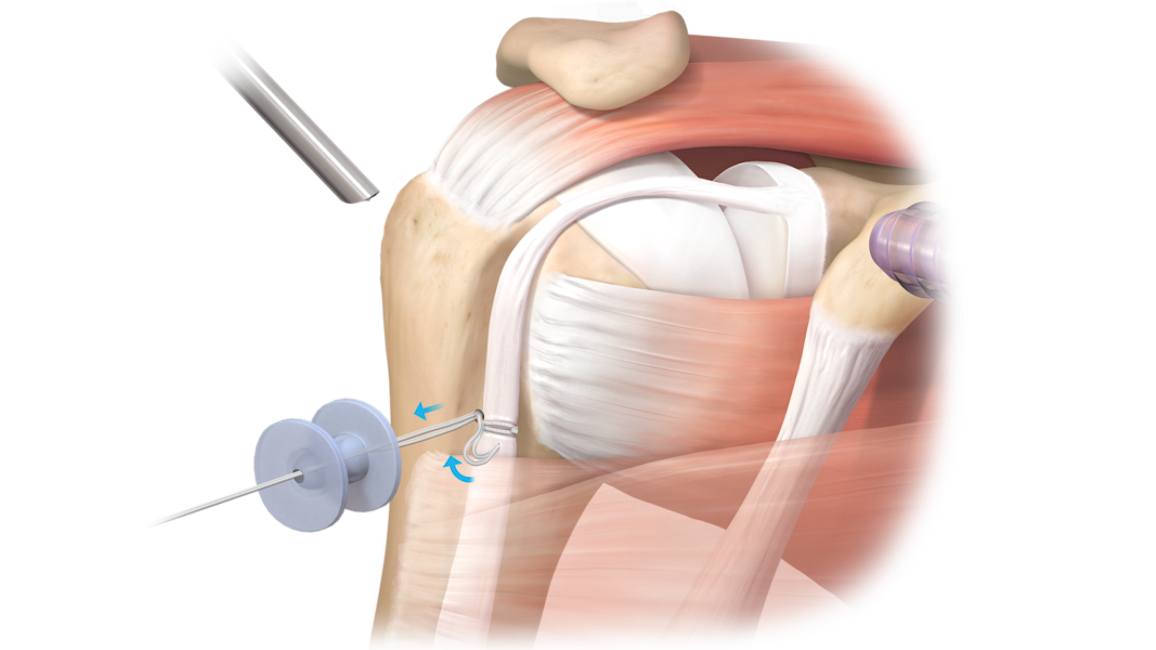 Técnica sin nudos para tenodesis TensionTight™