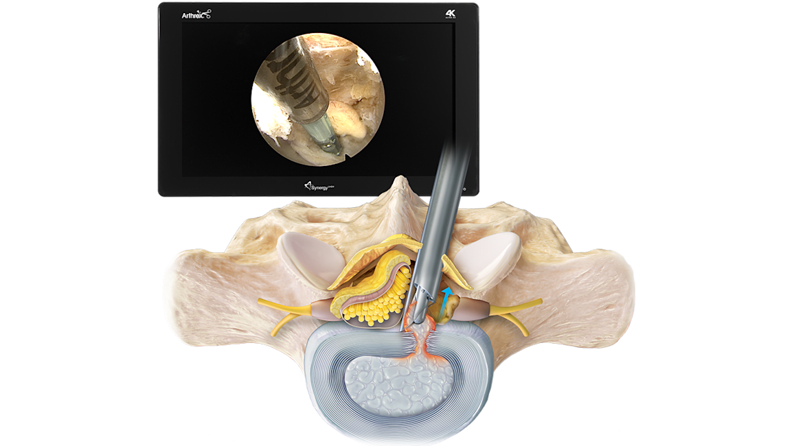 Interlaminar Endoscopic Discectomy