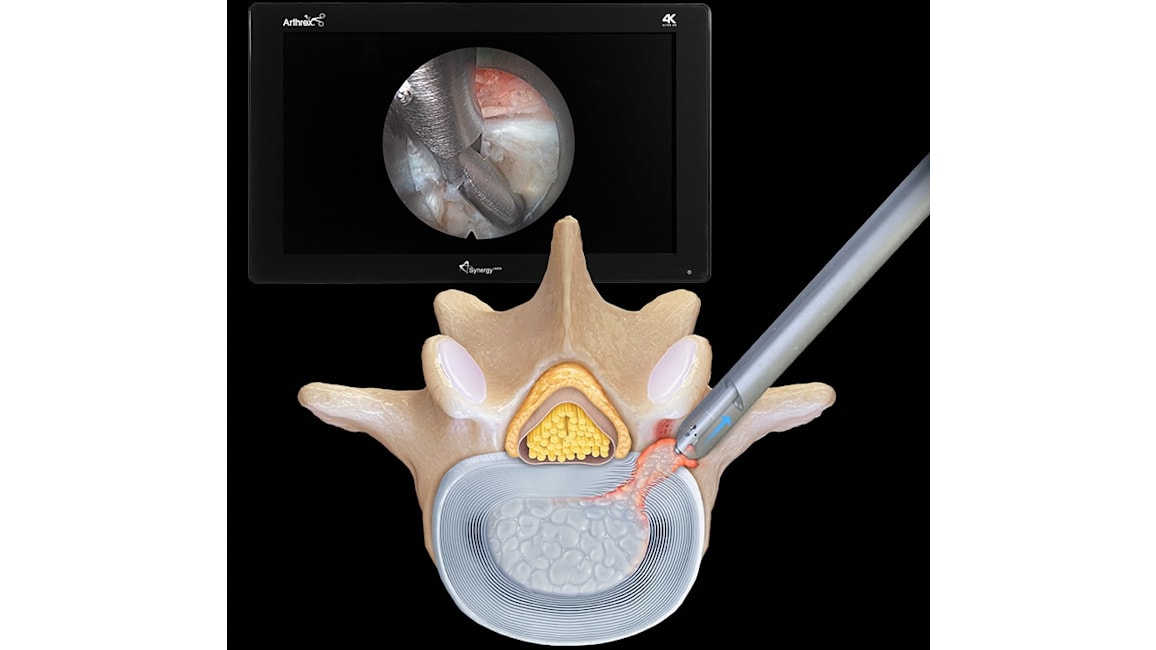 Transforaminal Endoscopic Discectomy