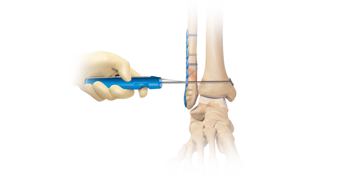 Sistema de implante TightRope<sup>®</sup> XP sindesmosis 