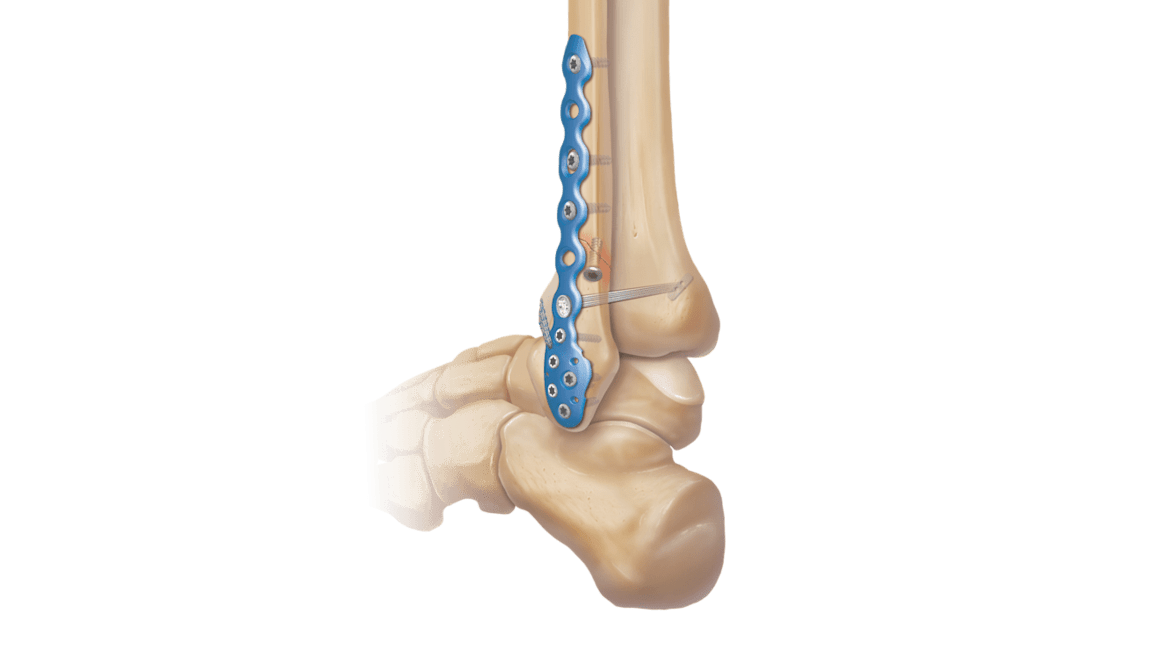 Ankle Fracture System™ aus Titan