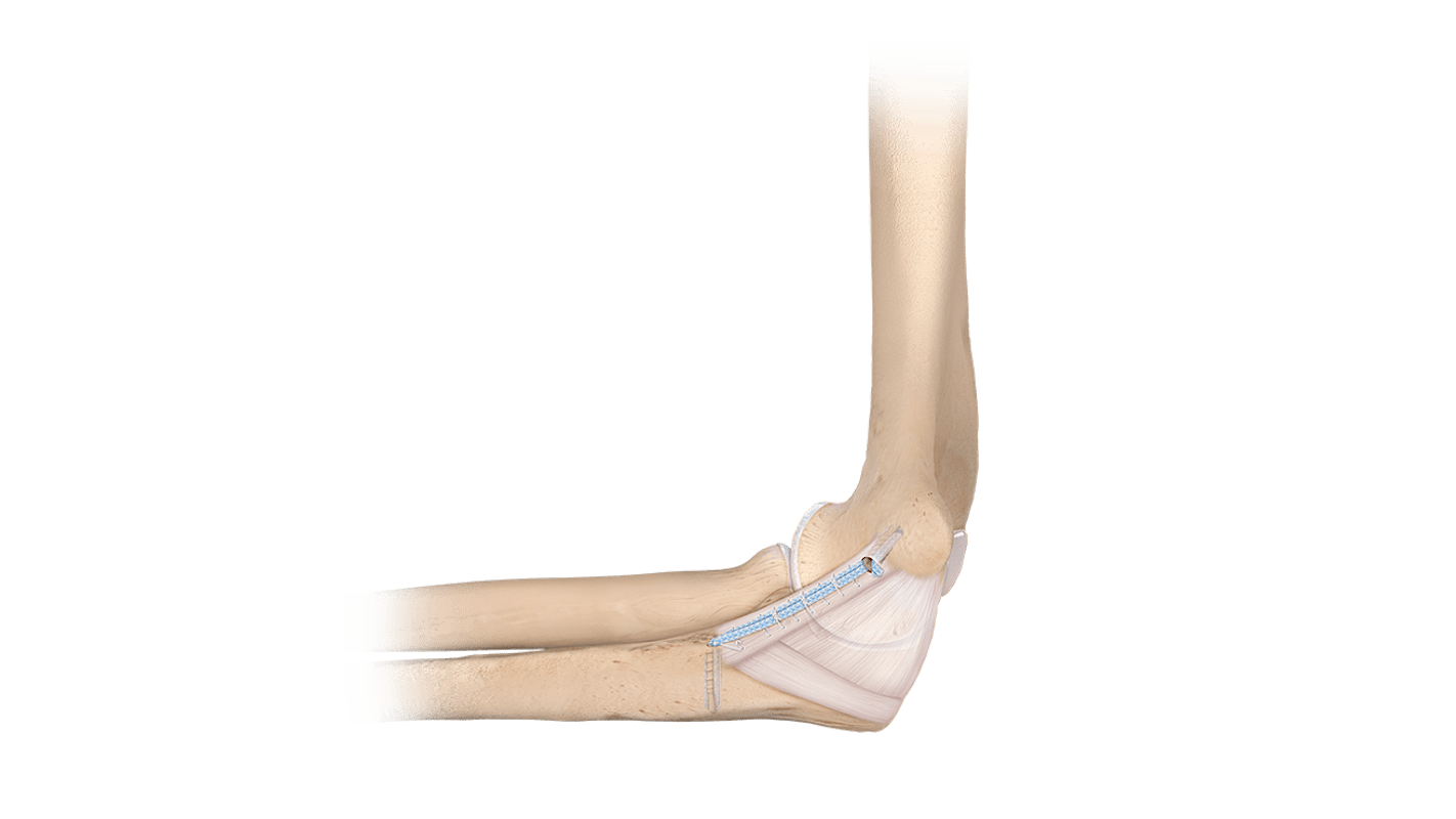 UCL <em>Internal</em>Brace™ System
