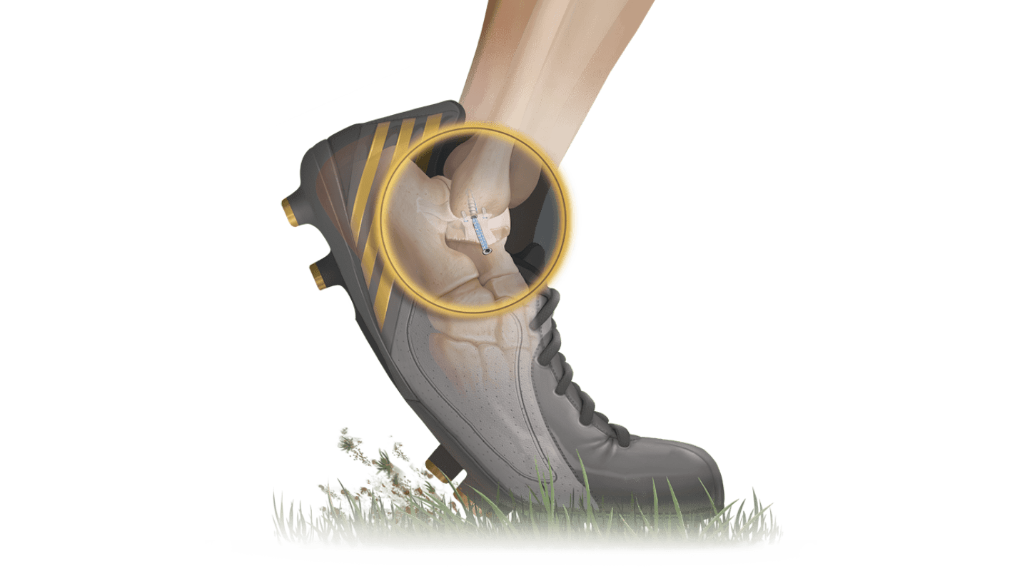 <em>Internal</em>Brace™ Technique for Brostrom Repair