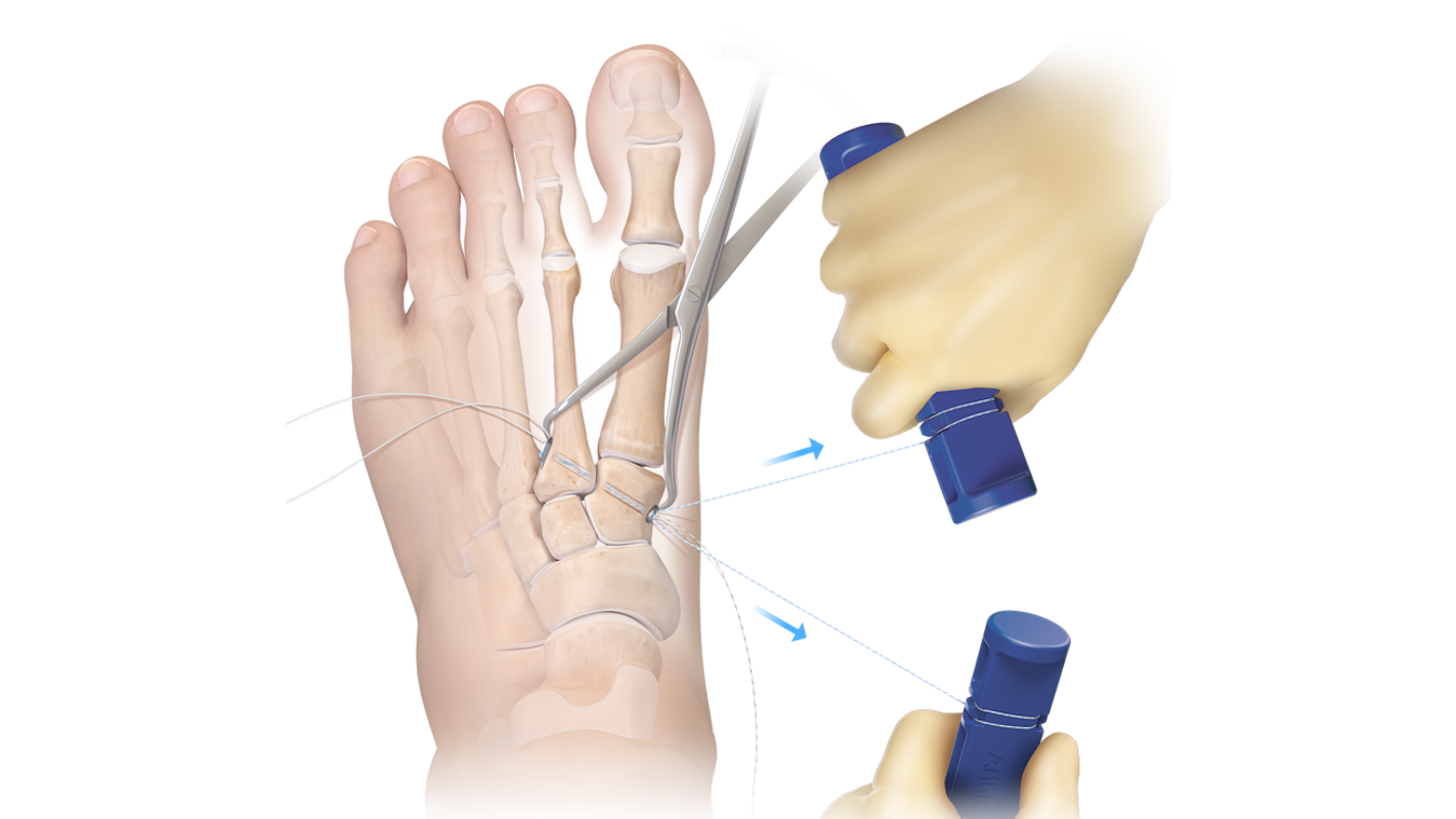 Mini TightRope<sup>®</sup> Fixation System