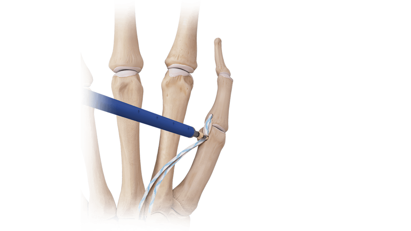 Hand/Wrist <em>Internal</em>Brace™ Ligament Augmentation Repair