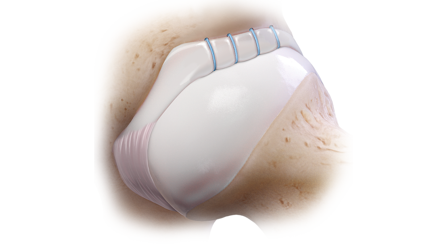Knotless Hip FiberTak<sup>®</sup> Soft Anchors
