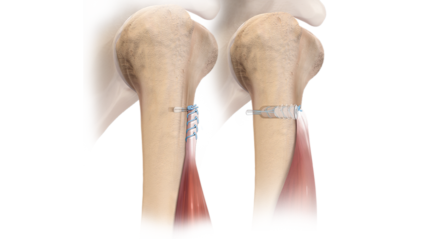 FiberTak<sup>®</sup> Button Tenodesis Technique