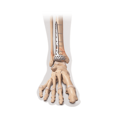 Internal Fixation for Distal Tibia Fracture/Pilon