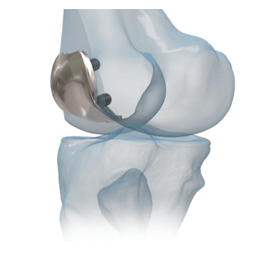 iBalance<sup>®</sup> PFJ System