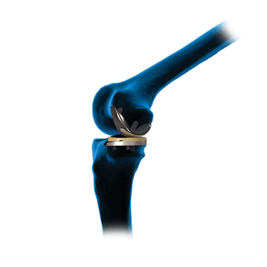 iBalance<sup>®</sup> UKA System 