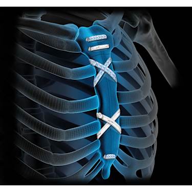 FiberTape® Sternal Closure
