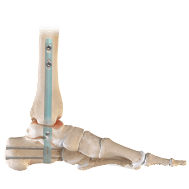 DualCompression Hindfoot Nail