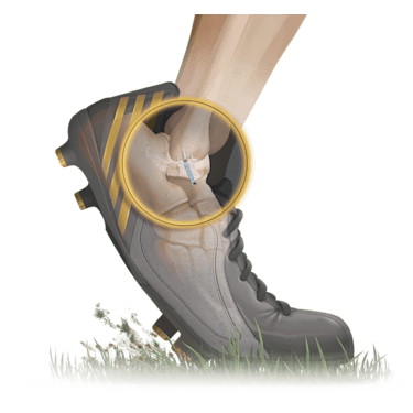 <em>Internal</em>Brace™ Technique for Brostrom Repair