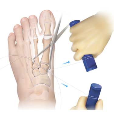 Mini TightRope<sup>®</sup> Fixation System