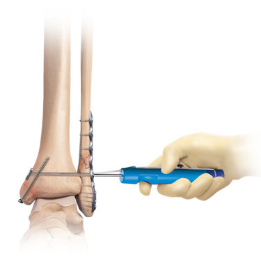 Sistema de manejo de fracturas para el tobillo