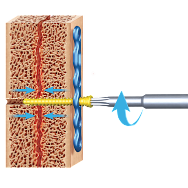 KreuLock™ Locking Compression Screws