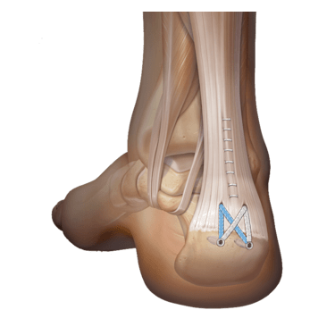 Achilles SpeedBridge™ Repair